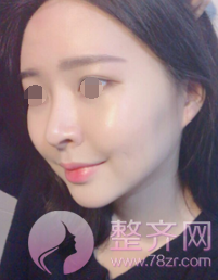 浙江自体脂肪全脸填充术后60天