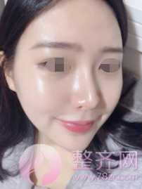 浙江自体脂肪全脸填充术后60天