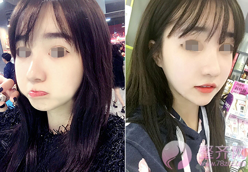 武汉假体隆鼻术后180天案例