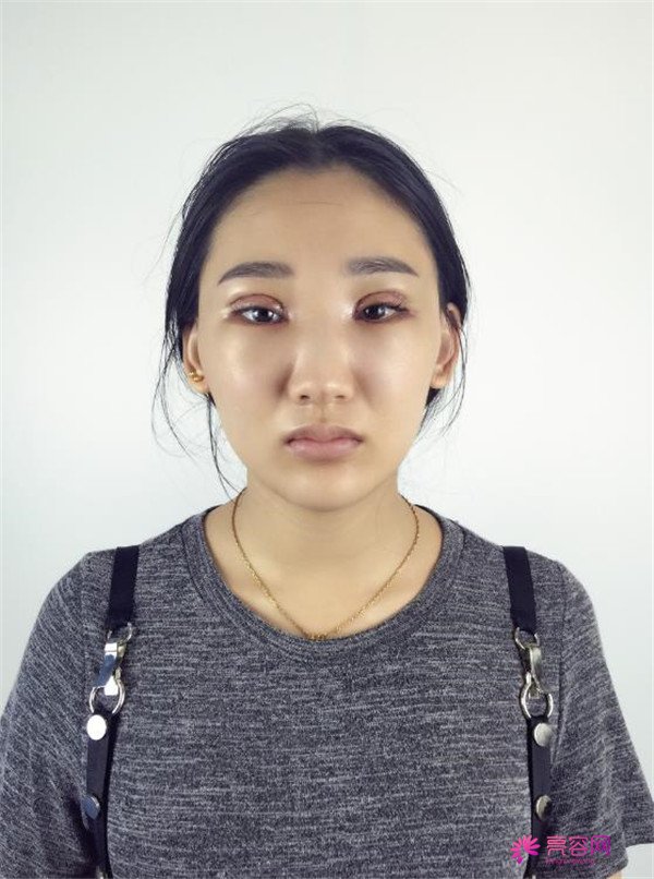 【全切双眼皮四个月案例分享】哈喽宝宝们,进来看看我是怎么从小眼睛单眼皮逆袭成大眼女神的