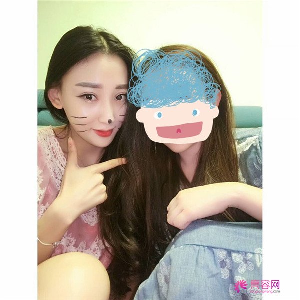 【全切双眼皮四个月案例分享】哈喽宝宝们,进来看看我是怎么从小眼睛单眼皮逆袭成大眼女神的