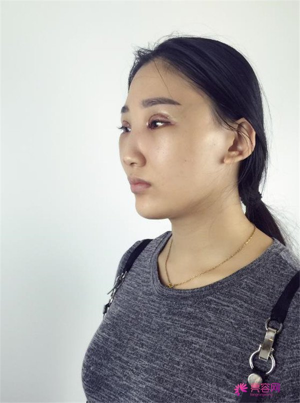 【全切双眼皮四个月案例分享】哈喽宝宝们,进来看看我是怎么从小眼睛单眼皮逆袭成大眼女神的