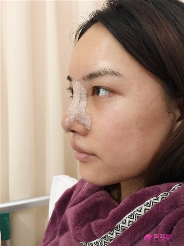 仙女们,拥有一个高而挺的鼻子是我很向往的,做了鼻部手术,我也有高而挺的鼻子啦~~~~