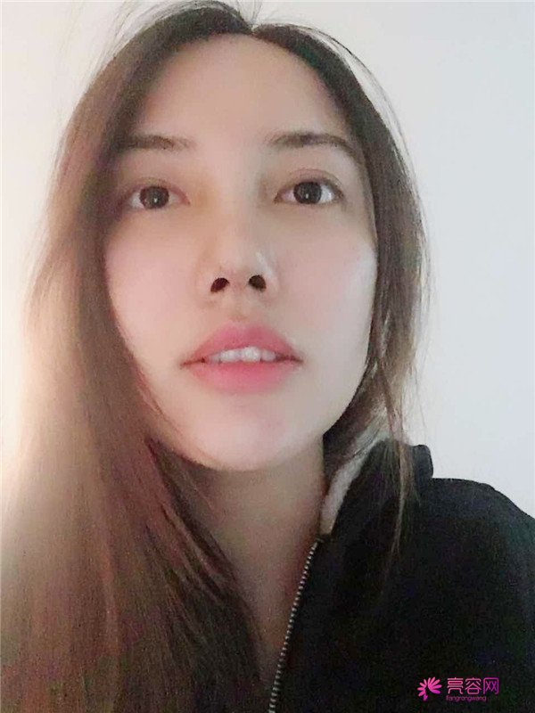 仙女们,拥有一个高而挺的鼻子是我很向往的,做了鼻部手术,我也有高而挺的鼻子啦~~~~