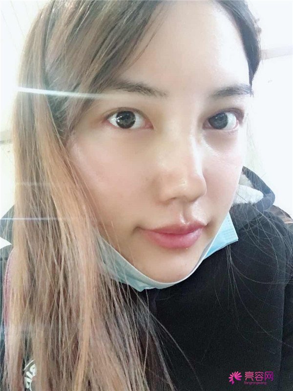 仙女们,拥有一个高而挺的鼻子是我很向往的,做了鼻部手术,我也有高而挺的鼻子啦~~~~