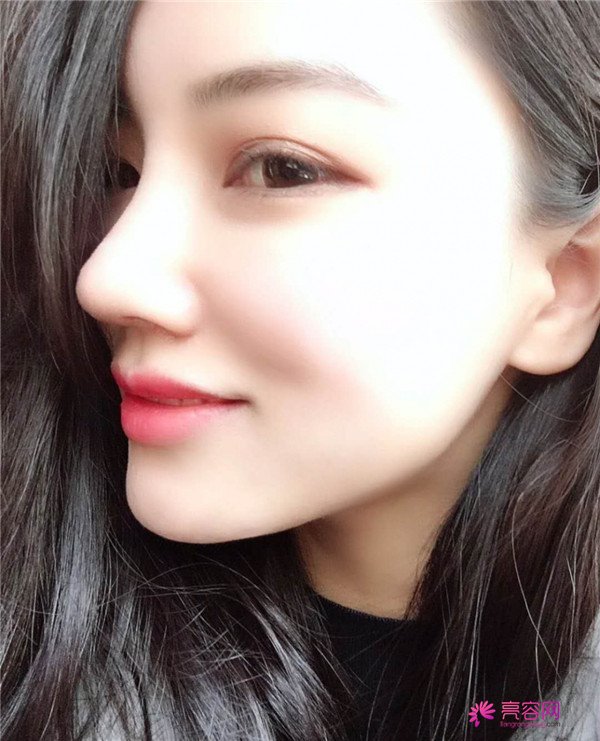 仙女们,拥有一个高而挺的鼻子是我很向往的,做了鼻部手术,我也有高而挺的鼻子啦~~~~