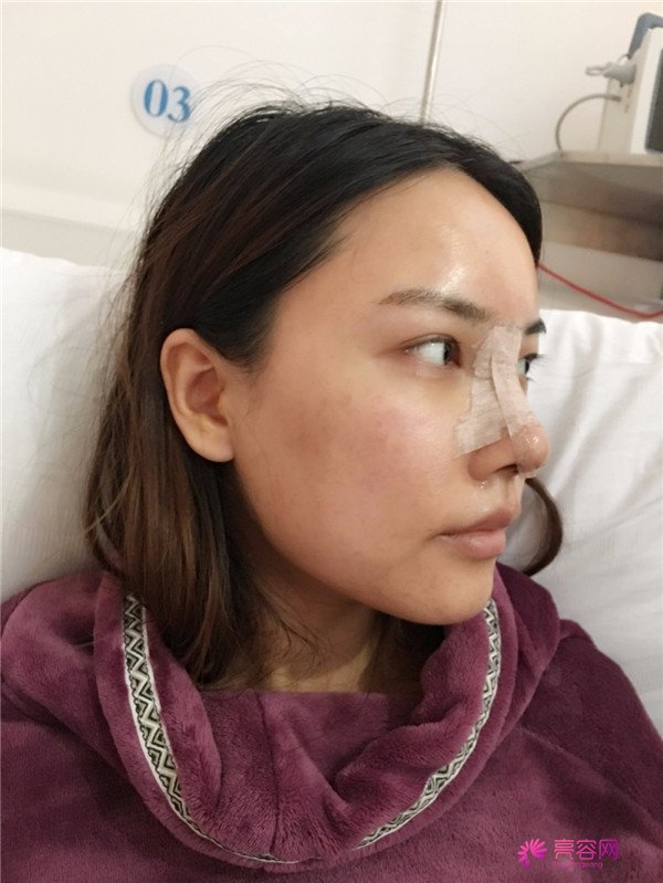 仙女们,拥有一个高而挺的鼻子是我很向往的,做了鼻部手术,我也有高而挺的鼻子啦~~~~