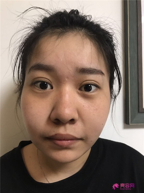 我的鼻部手术案例,大家都进来看看吧!从塌鼻子到小翘鼻,只用了三个月哈哈哈~~~~真是太值得