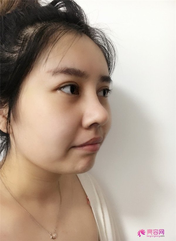 我的鼻部手术案例,大家都进来看看吧!从塌鼻子到小翘鼻,只用了三个月哈哈哈~~~~真是太值得