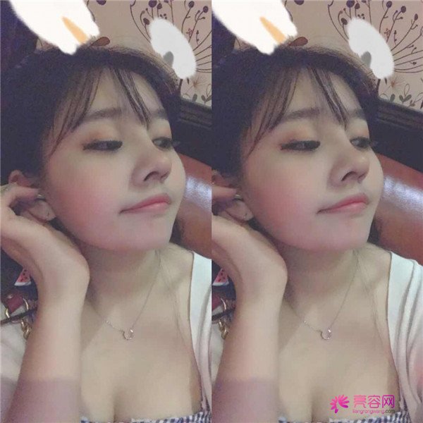 我的鼻部手术案例,大家都进来看看吧!从塌鼻子到小翘鼻,只用了三个月哈哈哈~~~~真是太值得