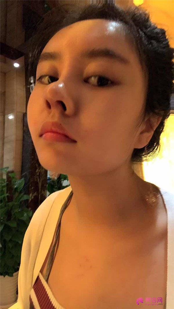我的鼻部手术案例,大家都进来看看吧!从塌鼻子到小翘鼻,只用了三个月哈哈哈~~~~真是太值得