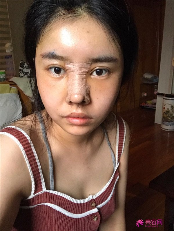 我的鼻部手术案例,大家都进来看看吧!从塌鼻子到小翘鼻,只用了三个月哈哈哈~~~~真是太值得
