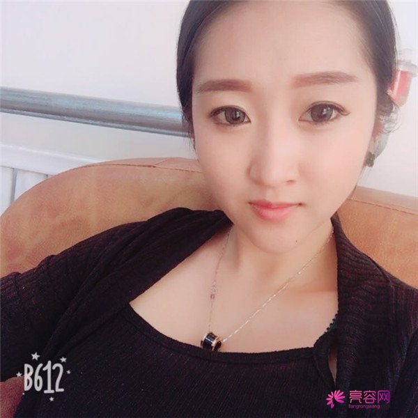 你们羡慕我的巴掌脸吗?真的只有巴掌大哦!哈哈宝宝们来看看我的案例吧,我只打了注射瘦脸哦