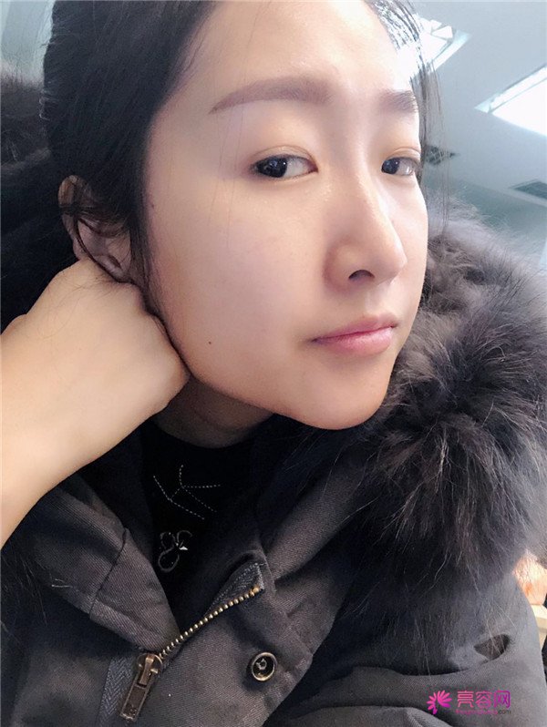 你们羡慕我的巴掌脸吗?真的只有巴掌大哦!哈哈宝宝们来看看我的案例吧,我只打了注射瘦脸哦