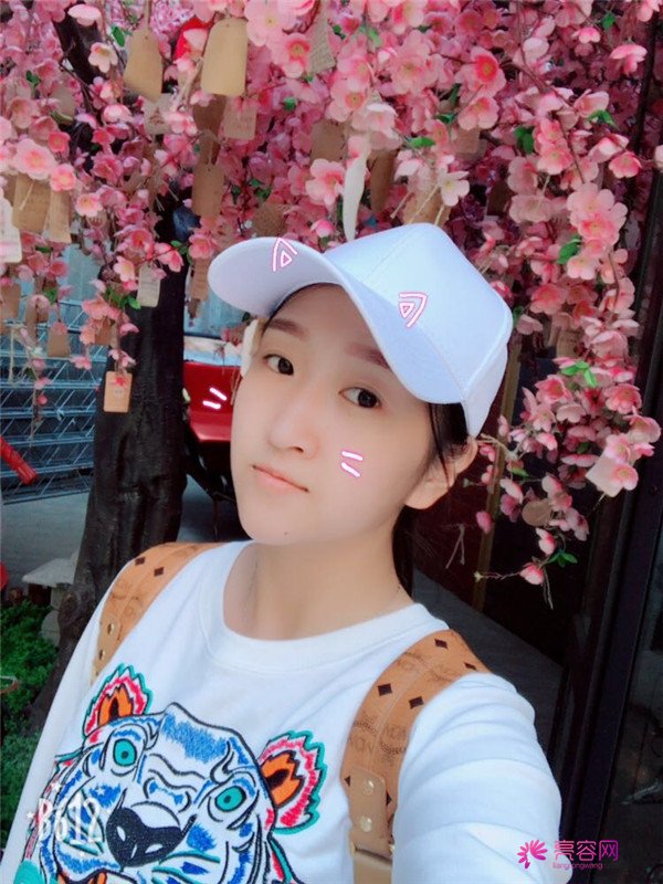 你们羡慕我的巴掌脸吗?真的只有巴掌大哦!哈哈宝宝们来看看我的案例吧,我只打了注射瘦脸哦