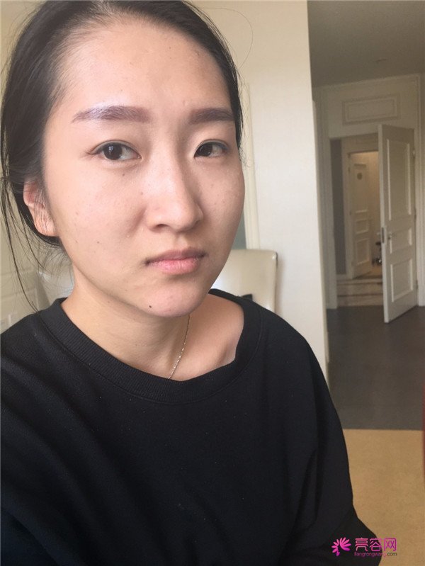 你们羡慕我的巴掌脸吗?真的只有巴掌大哦!哈哈宝宝们来看看我的案例吧,我只打了注射瘦脸哦
