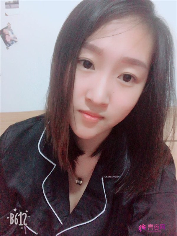 你们羡慕我的巴掌脸吗?真的只有巴掌大哦!哈哈宝宝们来看看我的案例吧,我只打了注射瘦脸哦