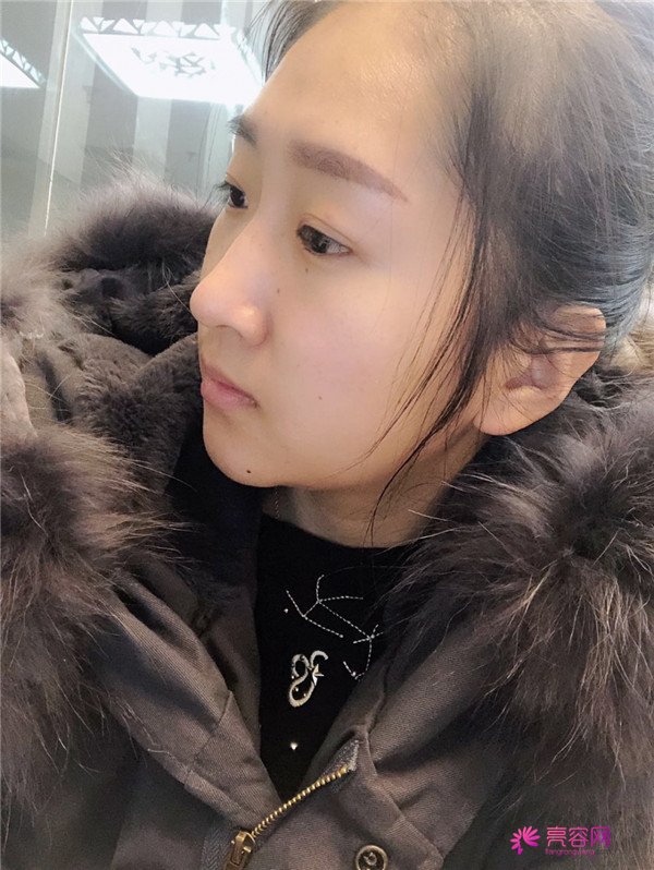 你们羡慕我的巴掌脸吗?真的只有巴掌大哦!哈哈宝宝们来看看我的案例吧,我只打了注射瘦脸哦