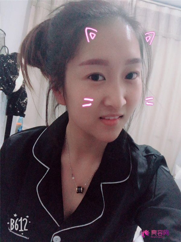 你们羡慕我的巴掌脸吗?真的只有巴掌大哦!哈哈宝宝们来看看我的案例吧,我只打了注射瘦脸哦