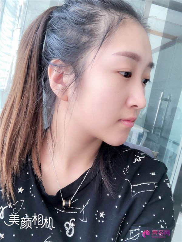 你们羡慕我的巴掌脸吗?真的只有巴掌大哦!哈哈宝宝们来看看我的案例吧,我只打了注射瘦脸哦