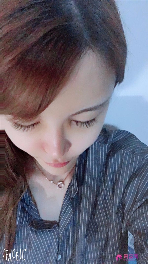 宝宝们,我去做了自体脂肪填充脸部,悄悄告诉你们,别人都看不出来我做了哈哈哈~~