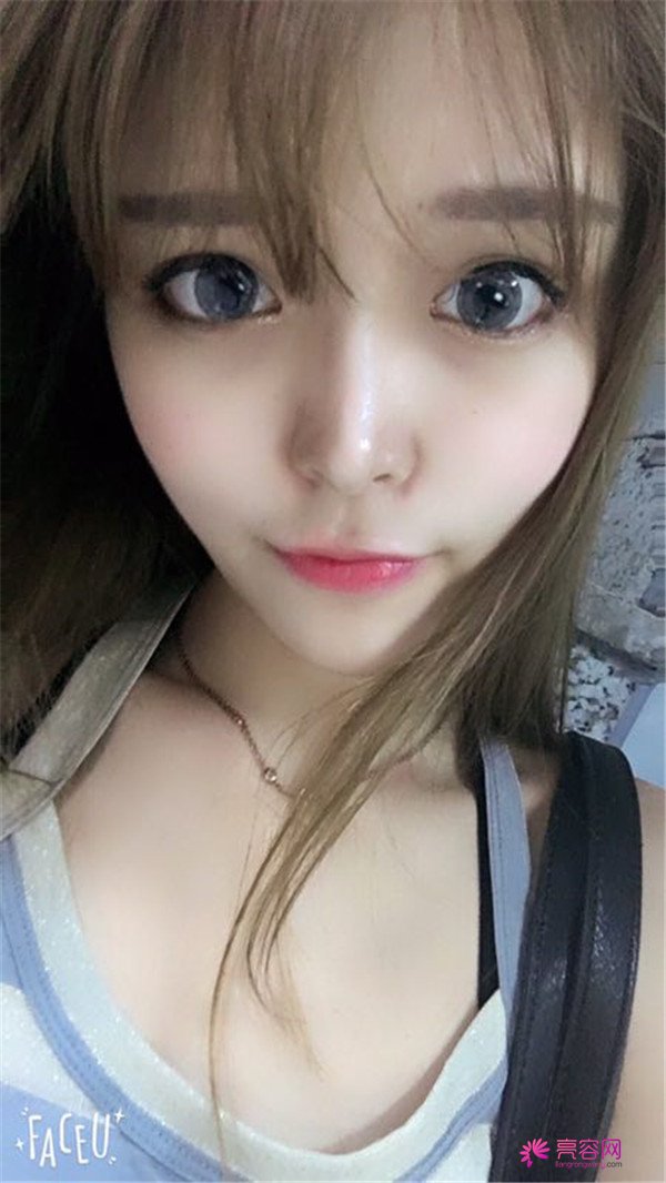 宝宝们,我去做了自体脂肪填充脸部,悄悄告诉你们,别人都看不出来我做了哈哈哈~~