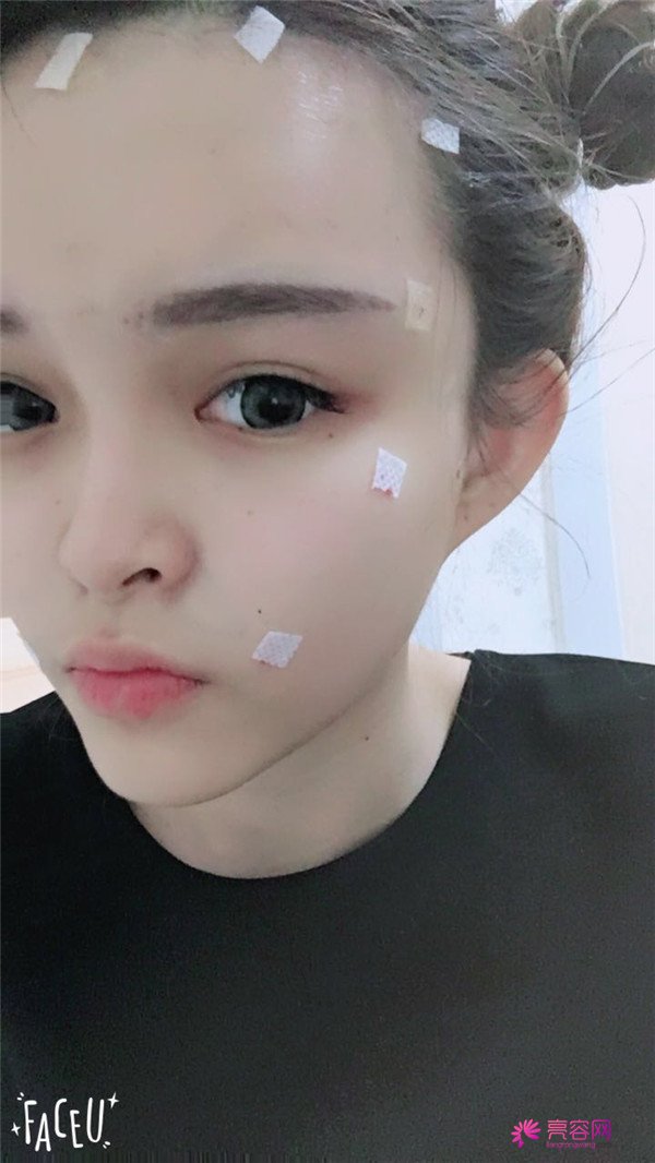 宝宝们,我去做了自体脂肪填充脸部,悄悄告诉你们,别人都看不出来我做了哈哈哈~~