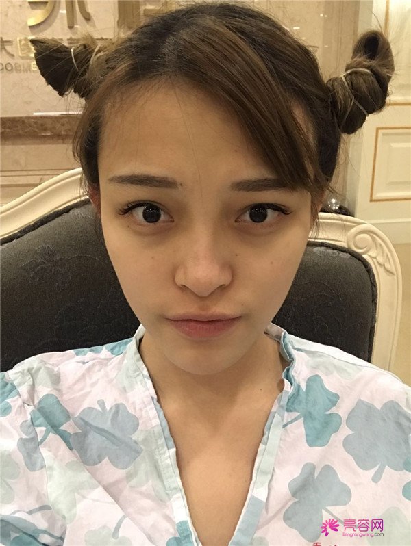 宝宝们,我去做了自体脂肪填充脸部,悄悄告诉你们,别人都看不出来我做了哈哈哈~~