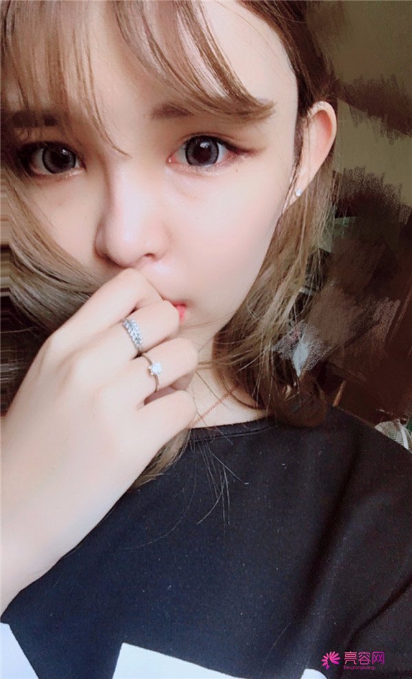 宝宝们,我去做了自体脂肪填充脸部,悄悄告诉你们,别人都看不出来我做了哈哈哈~~