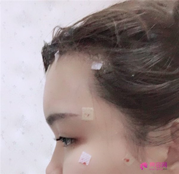 宝宝们,我去做了自体脂肪填充脸部,悄悄告诉你们,别人都看不出来我做了哈哈哈~~