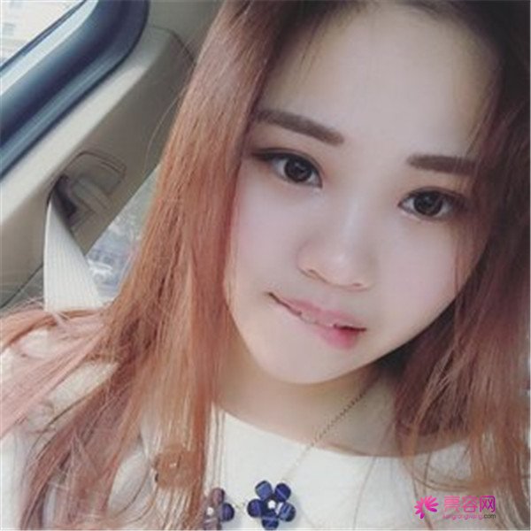 给你们分享我的全切双眼皮两个月案例啦~~~~想做双眼皮的小仙女们进来看看吧,我恢复的很好哦