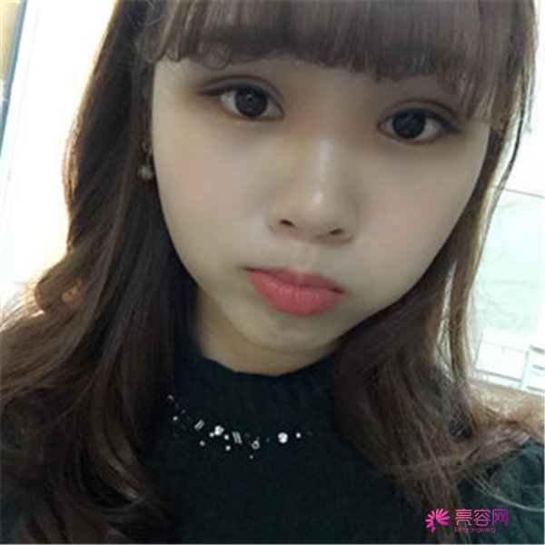 给你们分享我的全切双眼皮两个月案例啦~~~~想做双眼皮的小仙女们进来看看吧,我恢复的很好哦
