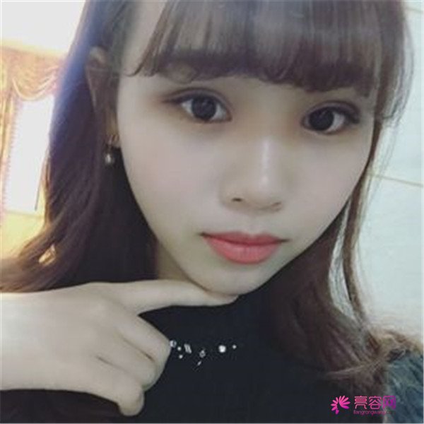 给你们分享我的全切双眼皮两个月案例啦~~~~想做双眼皮的小仙女们进来看看吧,我恢复的很好哦