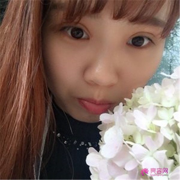给你们分享我的全切双眼皮两个月案例啦~~~~想做双眼皮的小仙女们进来看看吧,我恢复的很好哦