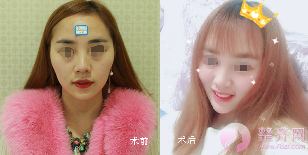长沙自体脂肪填充面部案例术后120天