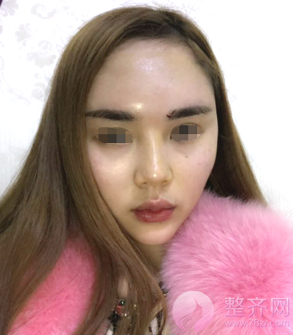 长沙自体脂肪填充面部案例术后120天