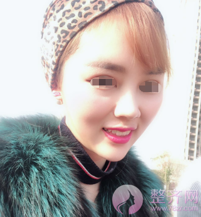 长沙自体脂肪填充面部案例术后120天