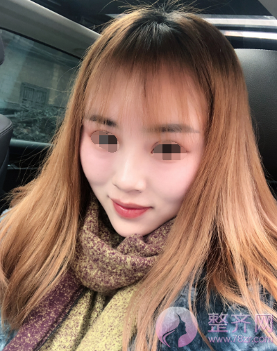 长沙自体脂肪填充面部案例术后120天