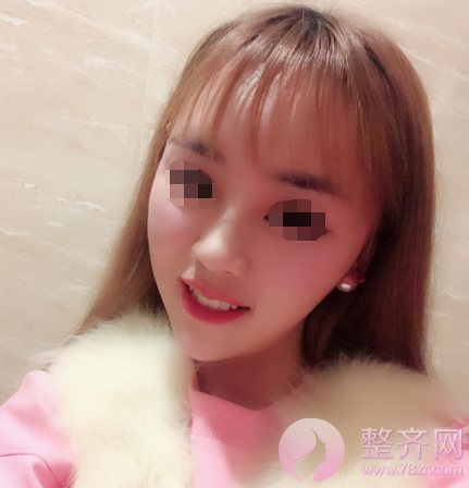长沙自体脂肪填充面部案例术后120天