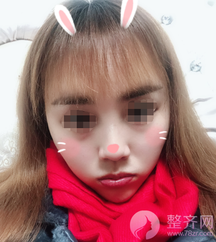 长沙自体脂肪填充面部案例术后120天