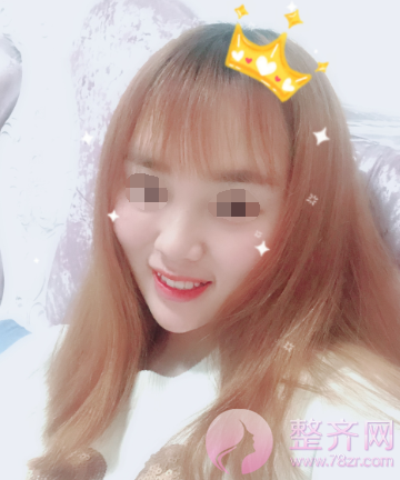 长沙自体脂肪填充面部案例术后120天