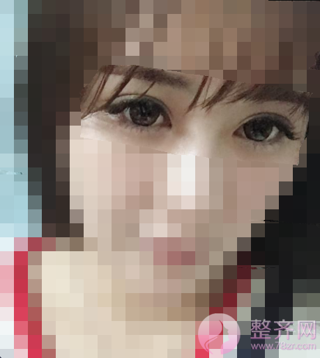 武汉全切双眼皮案例术后150天