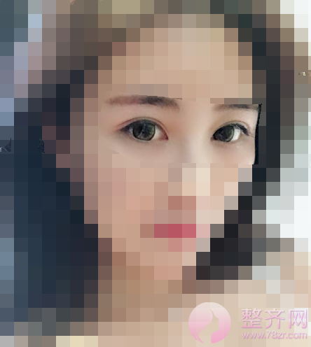 武汉全切双眼皮案例术后150天