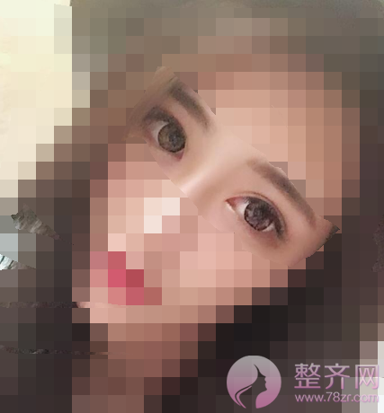 武汉全切双眼皮案例术后150天
