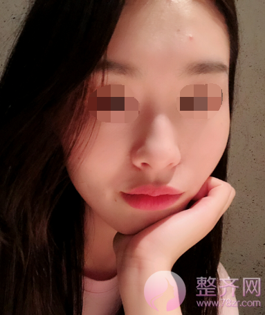 厦门膨体隆鼻术后85天案例