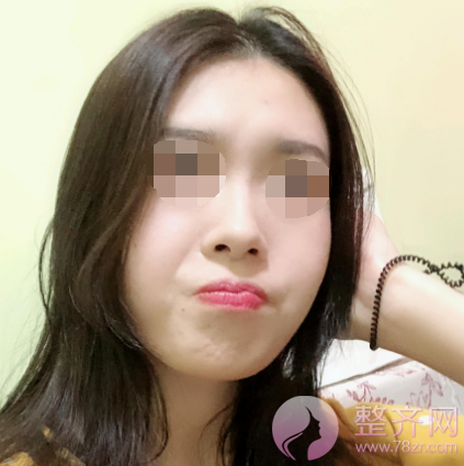 厦门膨体隆鼻术后85天案例