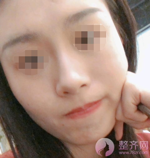 厦门膨体隆鼻术后85天案例