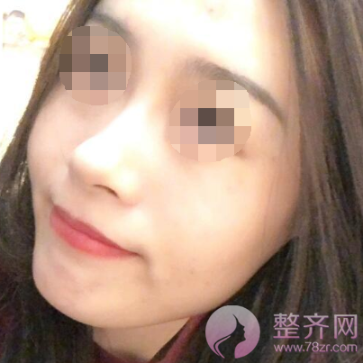 厦门膨体隆鼻术后85天案例