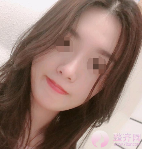 厦门膨体隆鼻术后85天案例