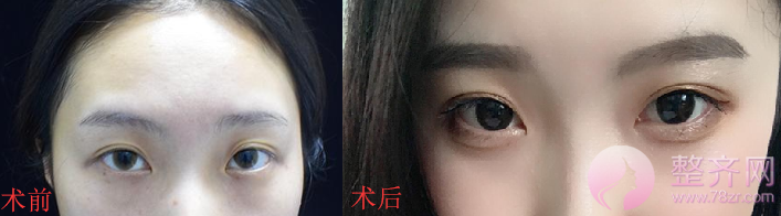 深圳眼部手术案例95天